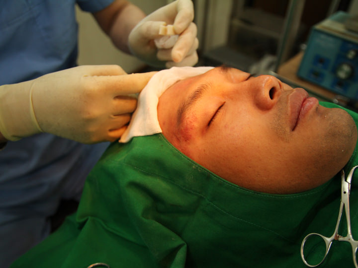 进行凹陷疤痕自体真皮再生术