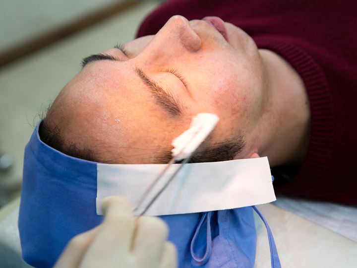 进行痘痕治疗咨询后,进行治疗,并对青春痘痕进行消毒.