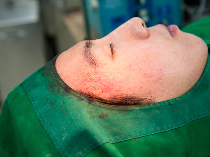 青春痘痕自体真皮再生术治疗结束