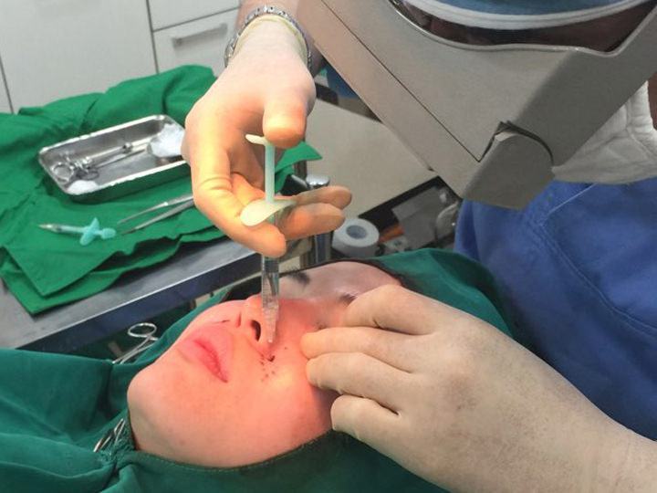 进行浅皱纹自体真皮再生术