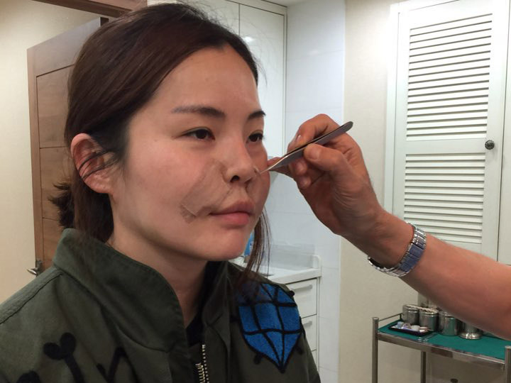 施术24小时后复查并取下医用纱布