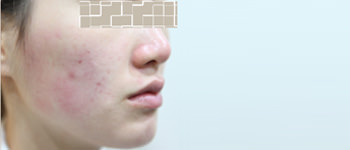 AFTER
(术后会有短暂的泛红现象)