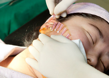 5.Ultra V面部提升术